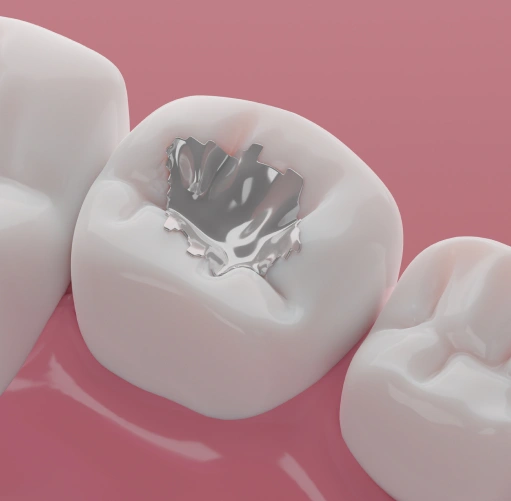 Dental Fillings