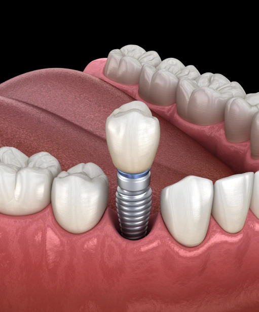 Dental Implants