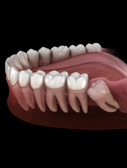 Wisdom Teeth Removal